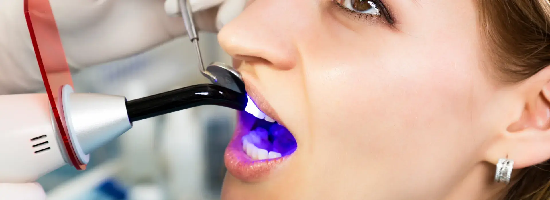 Dental Bonding at summerville dentist