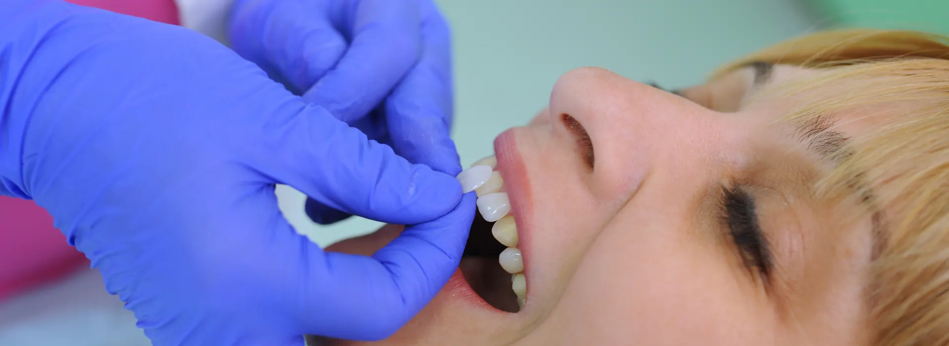 Dental Veneers summerville