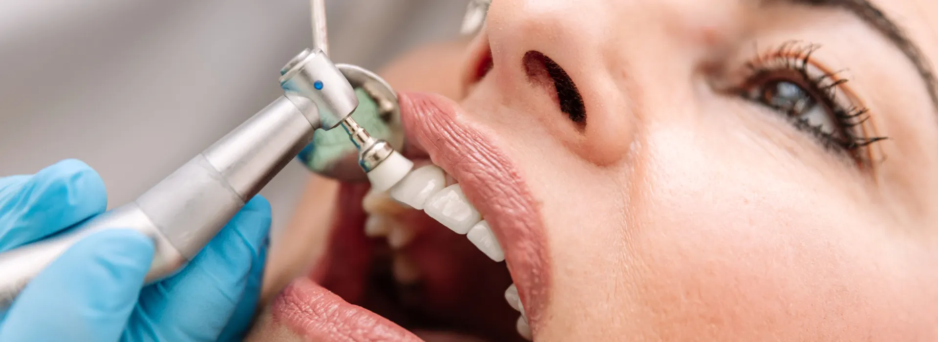 Professional Teeth Whitening Summerville