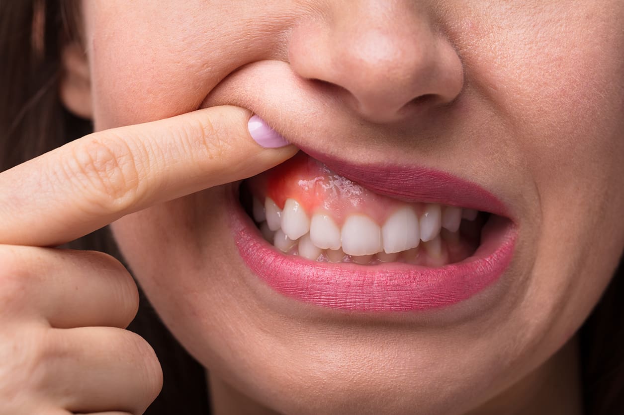 5 Causes of Swollen Gums and When to See a Dentist