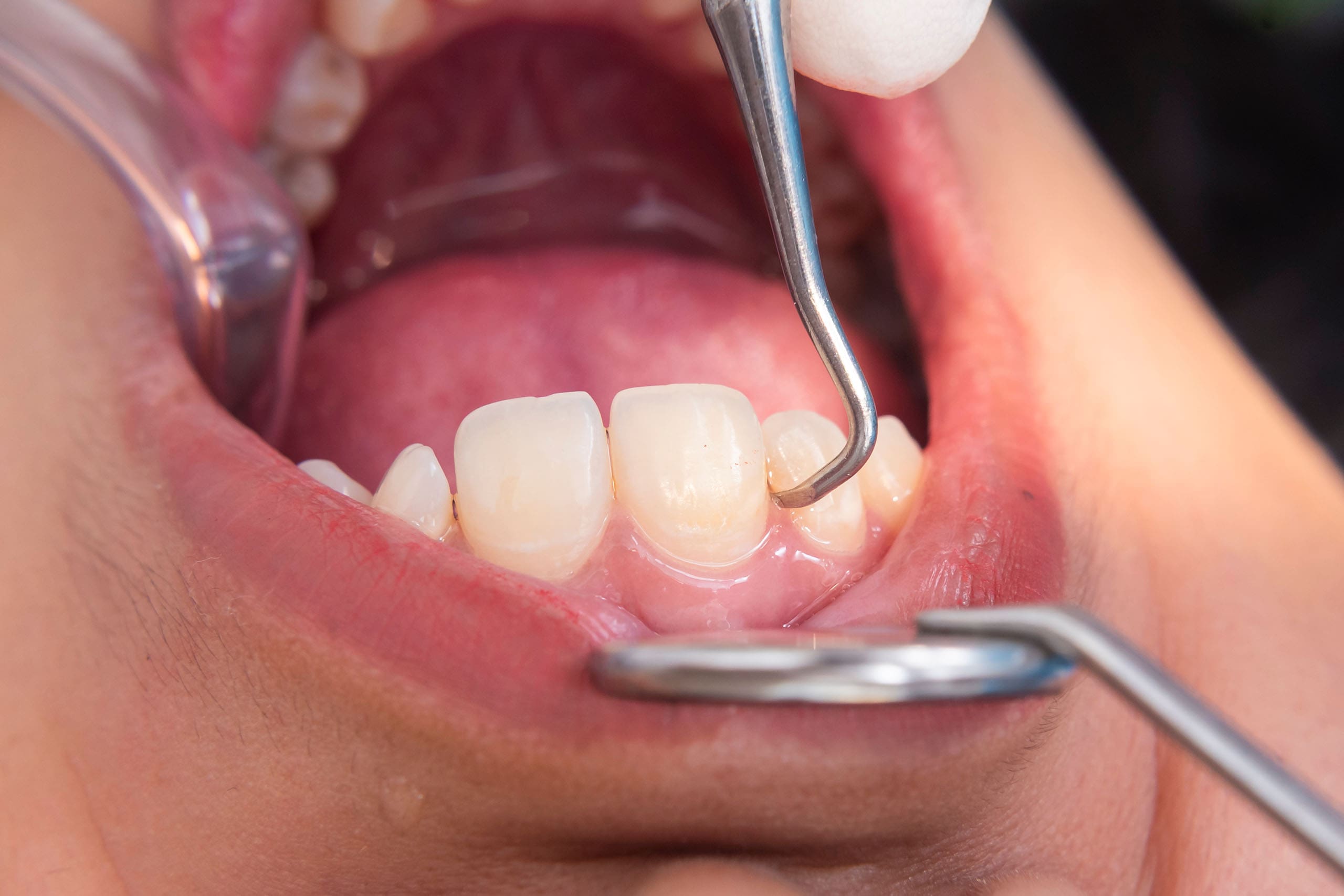 Plaque vs. Tartar: What Is the Difference?