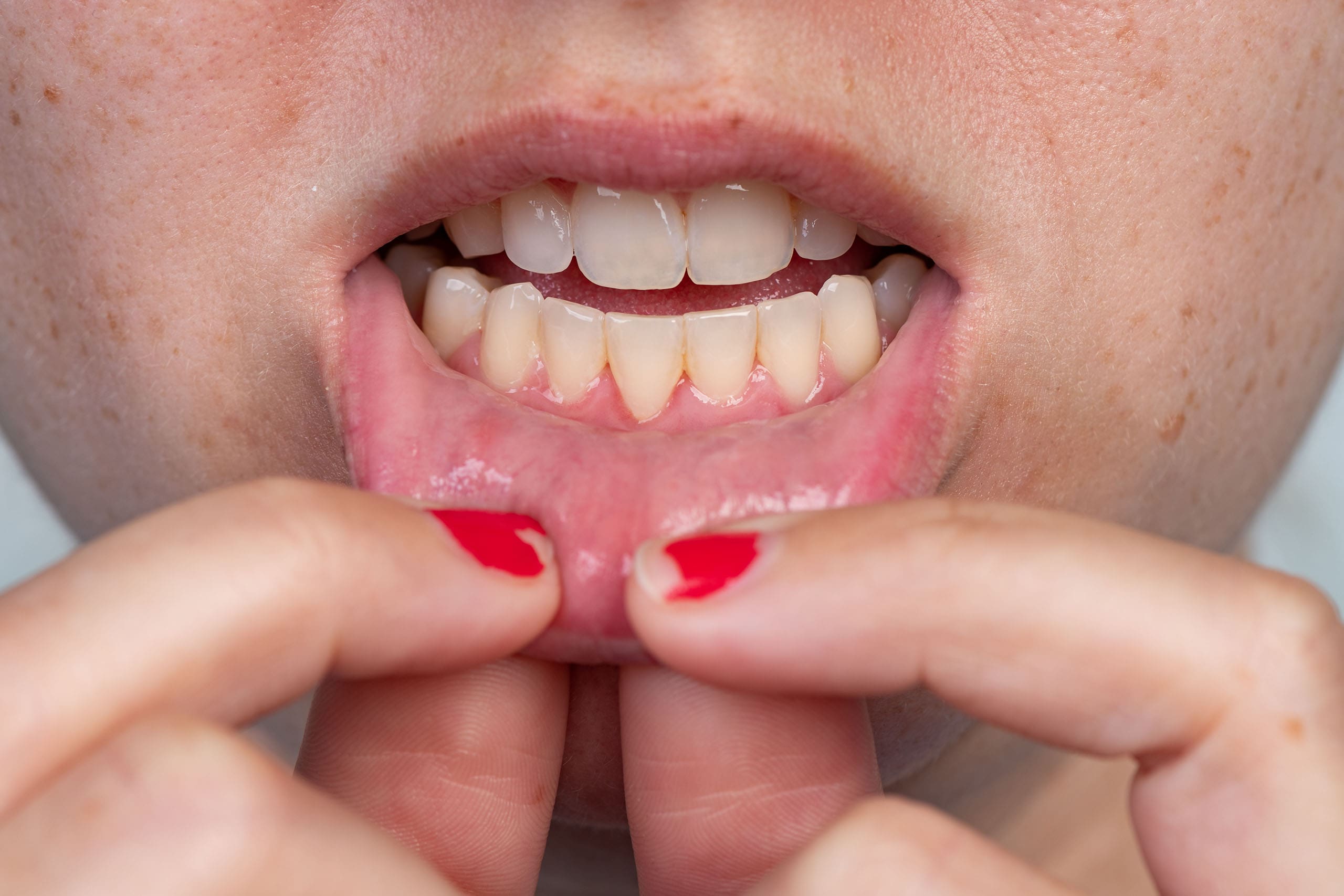 Can Gums Grow Back? What to Know About Receding Gums
