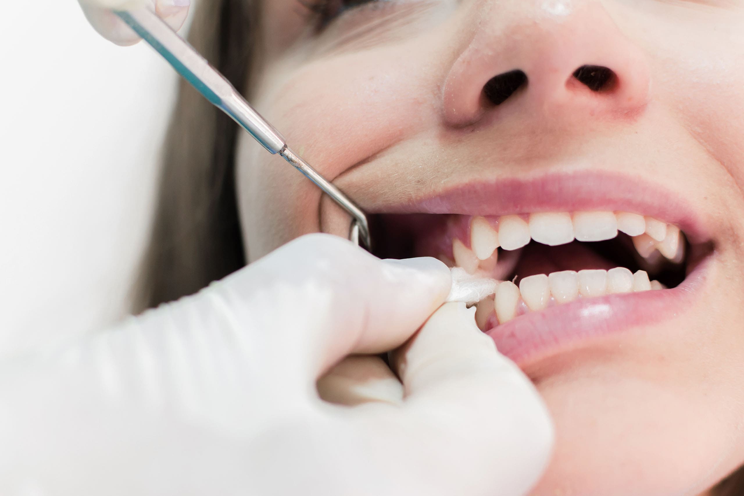 How Long to Keep Gauze in After Tooth Extraction